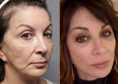 deep plane facelift before and after photos by sherber and rad in washington dc