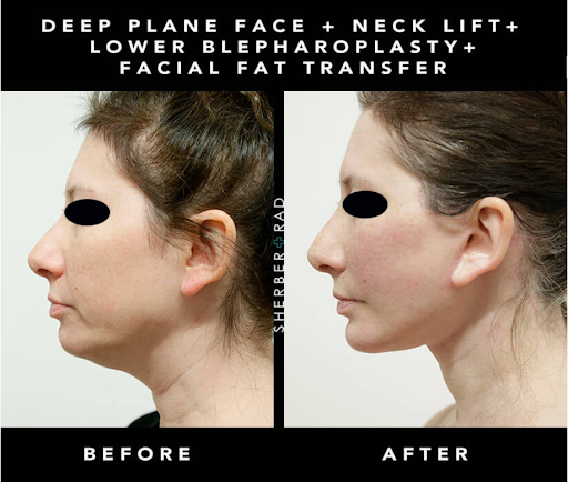 Before and after photos showing results of chin augmentation