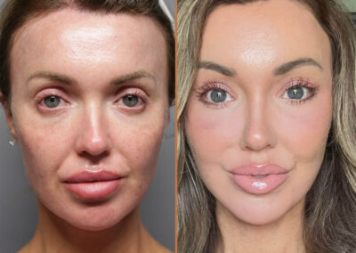 SMAS Facelift before and after photos by Sherber and Rad in Washington DC