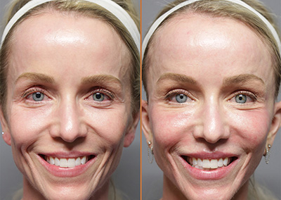 Facelift before and after photos by Sherber and Rad in Washington DC