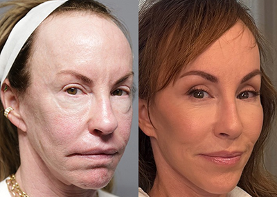 facelift browlift blepharoplasty fat grafting before and after photos by sherber and rad